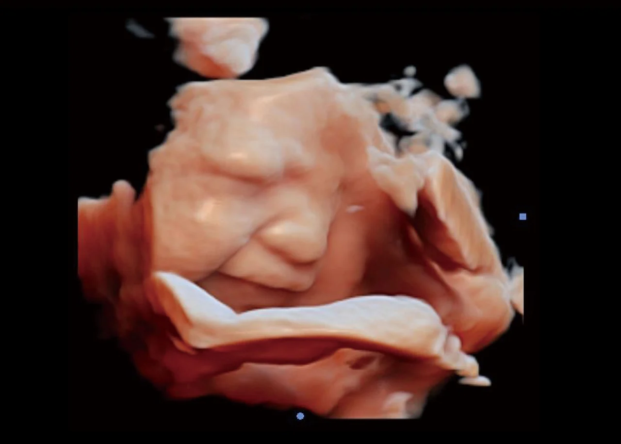 Cara fetal, Virtual HD