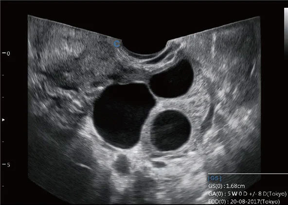 Sonda transvaginal de ángulo amplio
