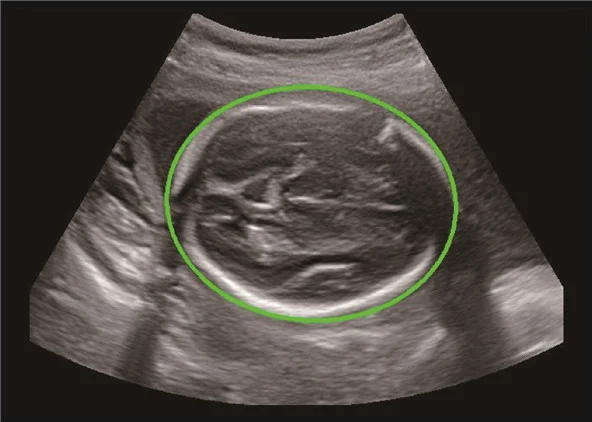 SonoAI-OB — biometría fetal