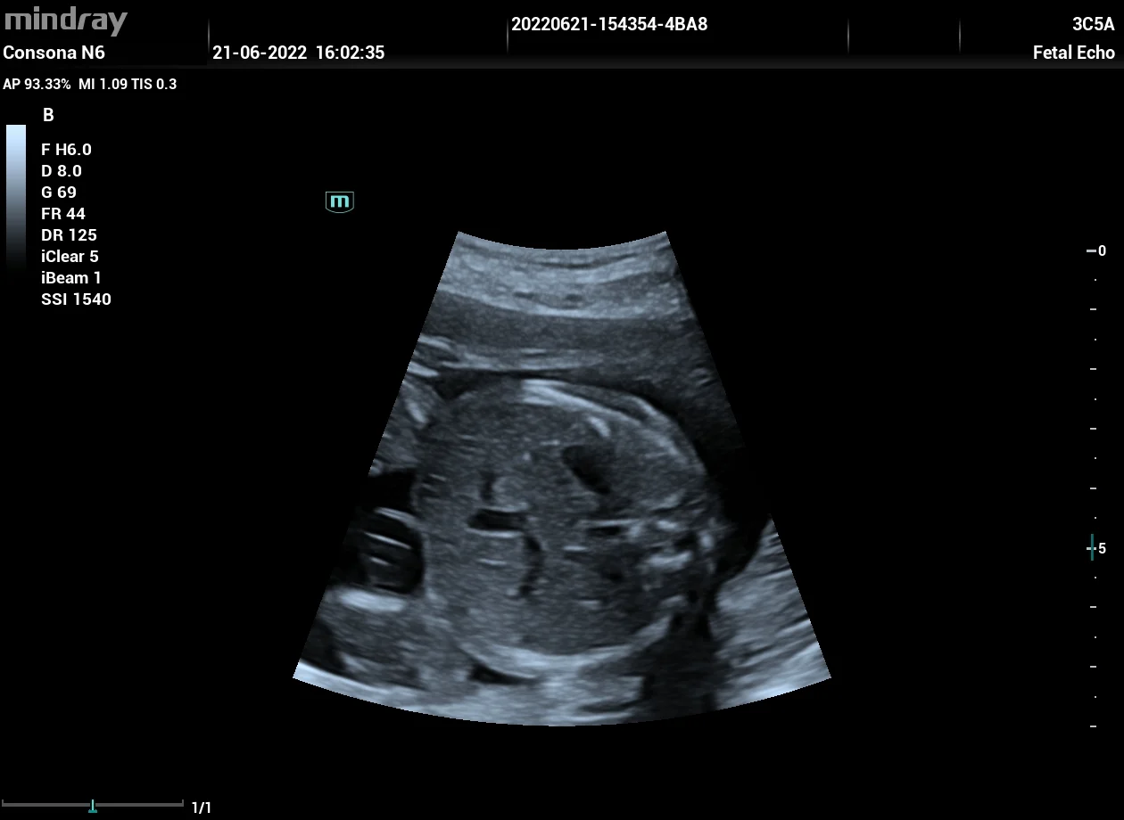 Abdomen fetal