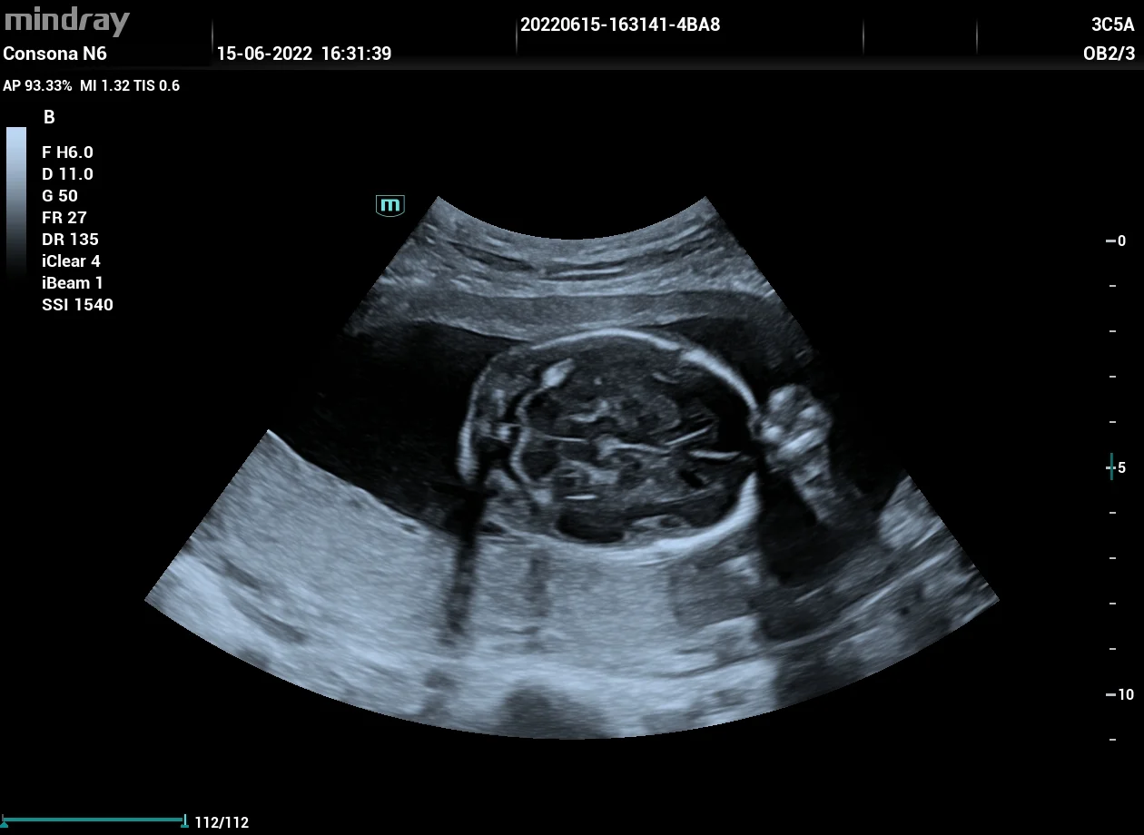 Cabeza fetal