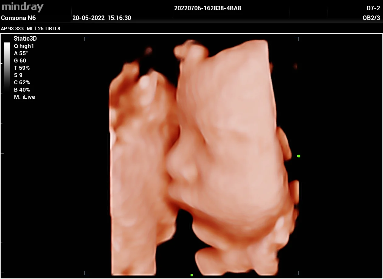 Cara fetal 3D