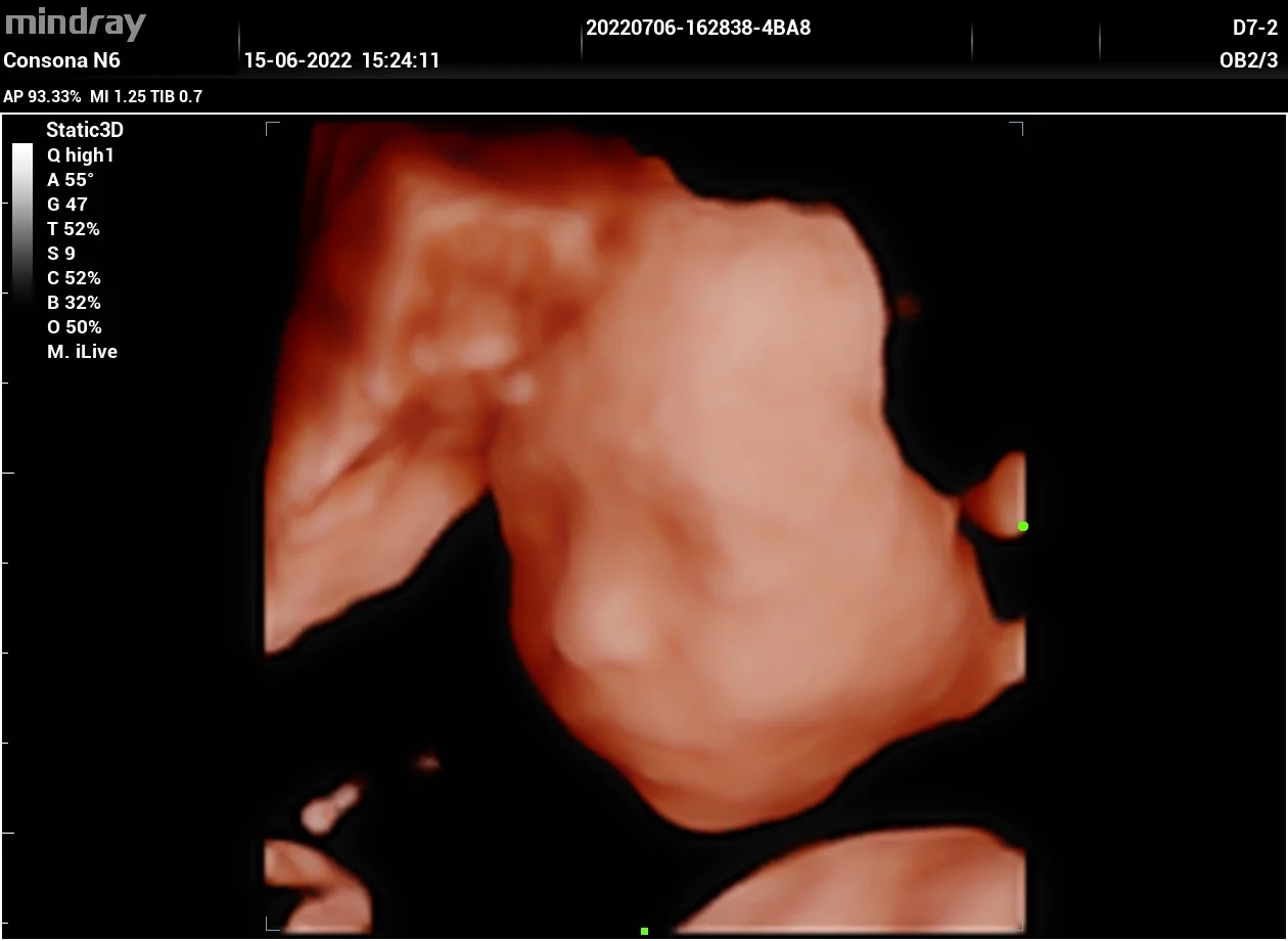 Cara fetal 3D con iLive