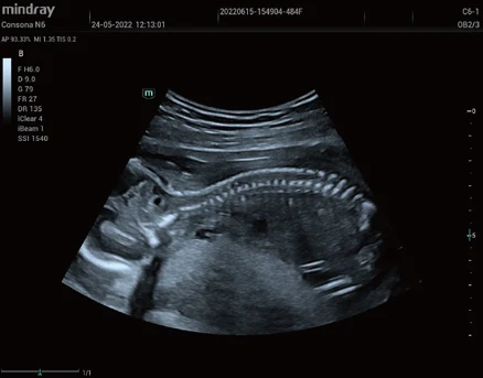 Columna dorsal fetal 2D