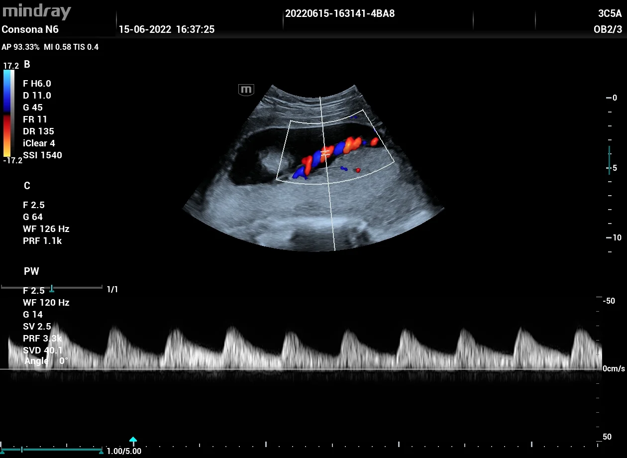 PW de cordón umbilical