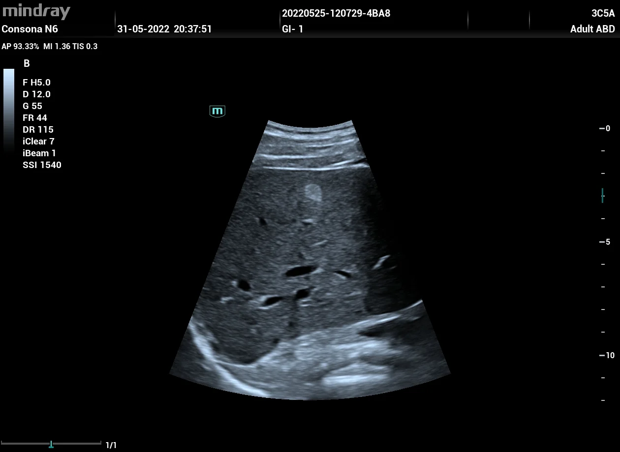 Hemangioma hepático