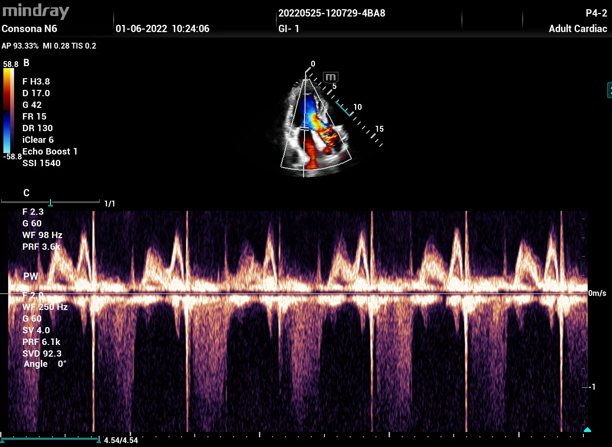 Insuficiencia mitral con CW