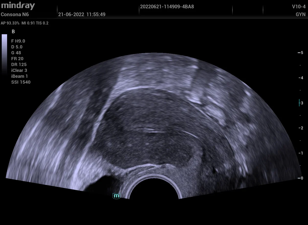 Útero por vía transvaginal