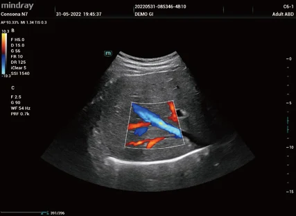 Vena hepática con CDI