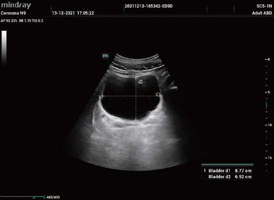 Medición automática del volumen vesical Smart Bladder en el Consona N6