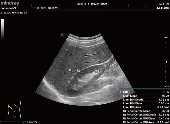 Cálculo automático del índice hepatorrenal Smart HRI en el Consona N6
