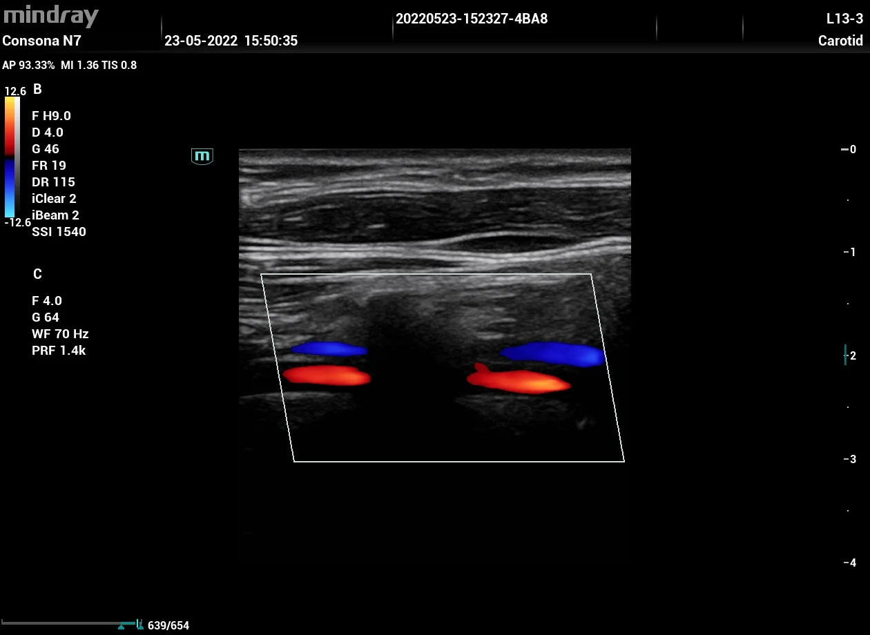 Arteria vertebral