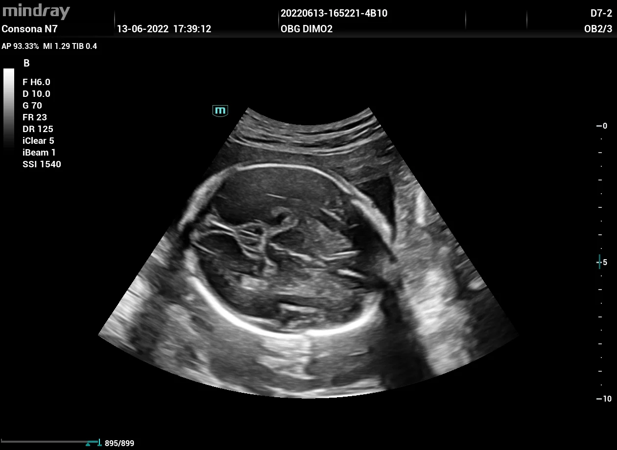 Cabeza fetal