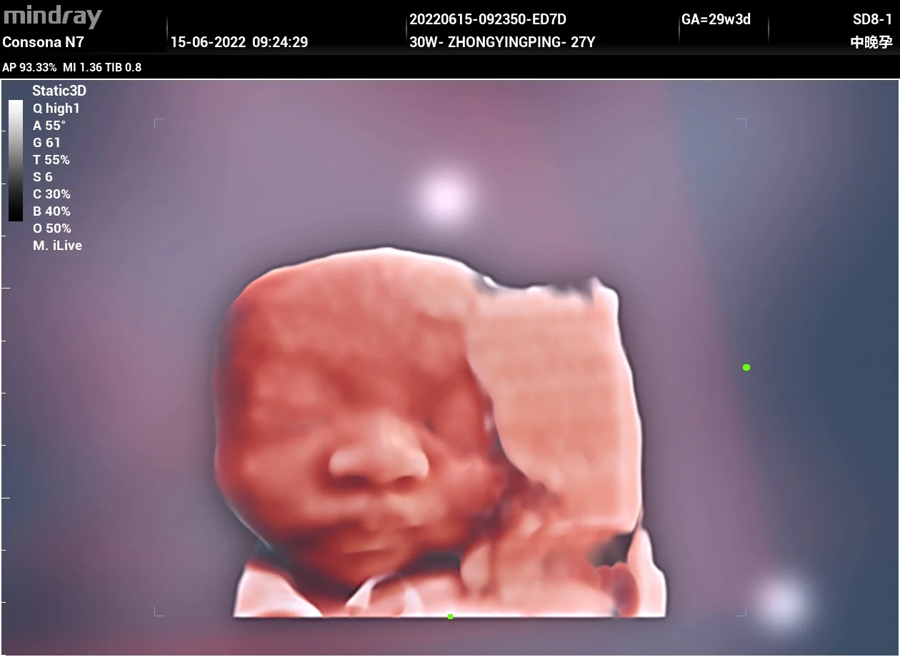 Cara fetal 3D con iLive