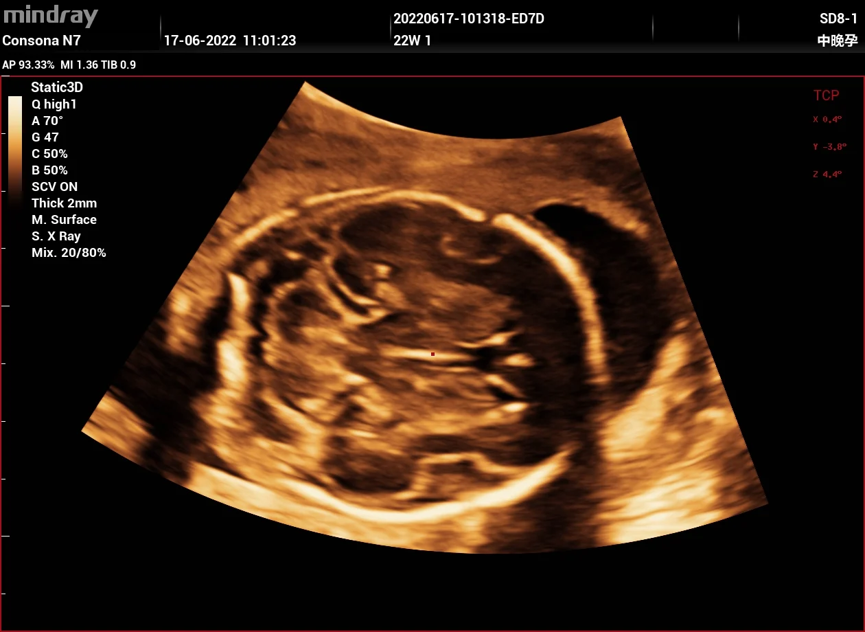 Cerebro fetal en 3D (MPR)