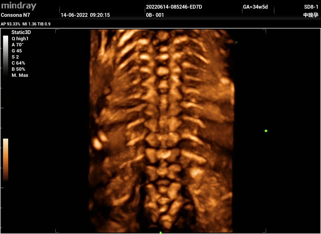 Columna fetal en 3D