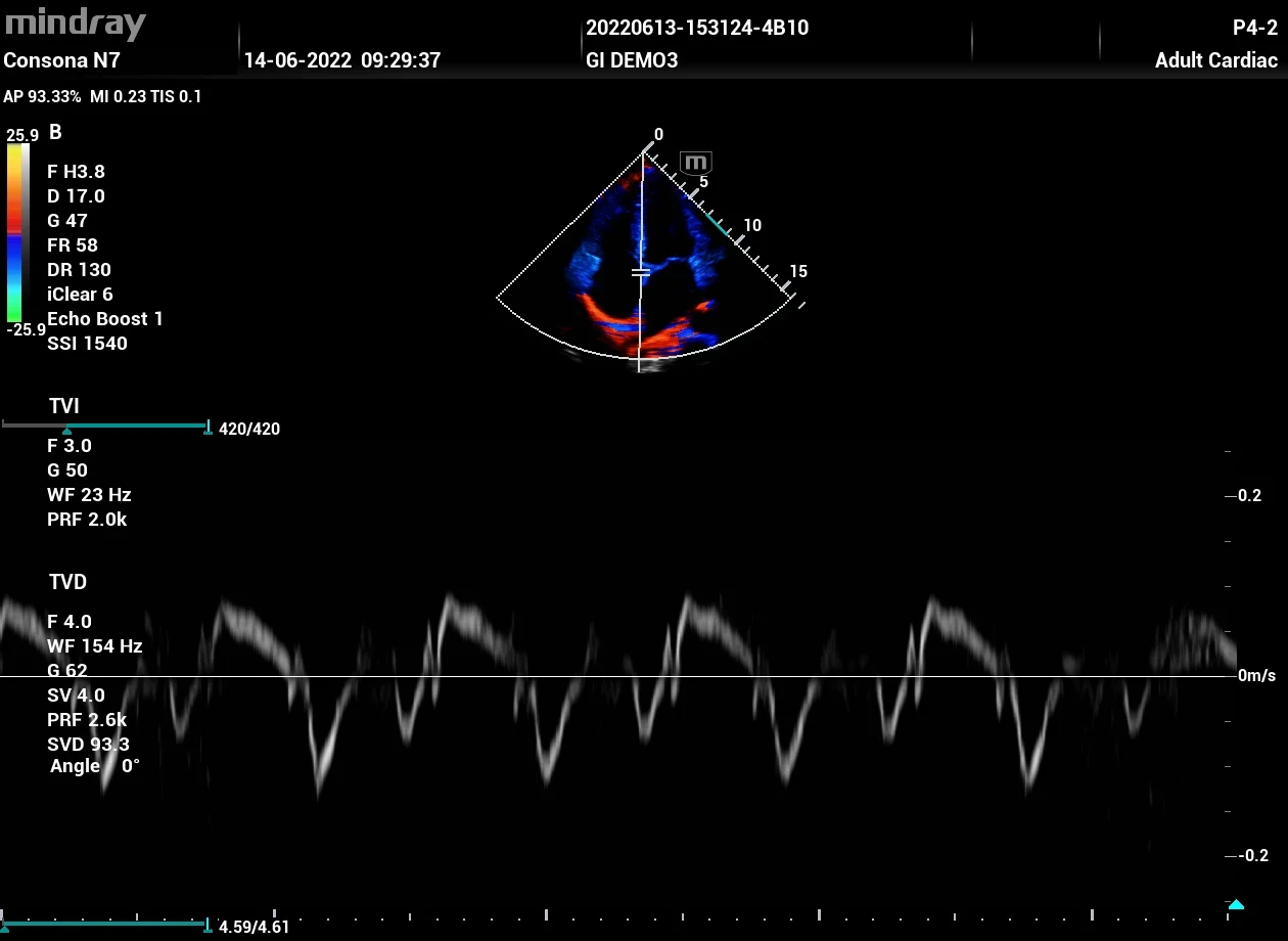Doppler tisular (TDI)