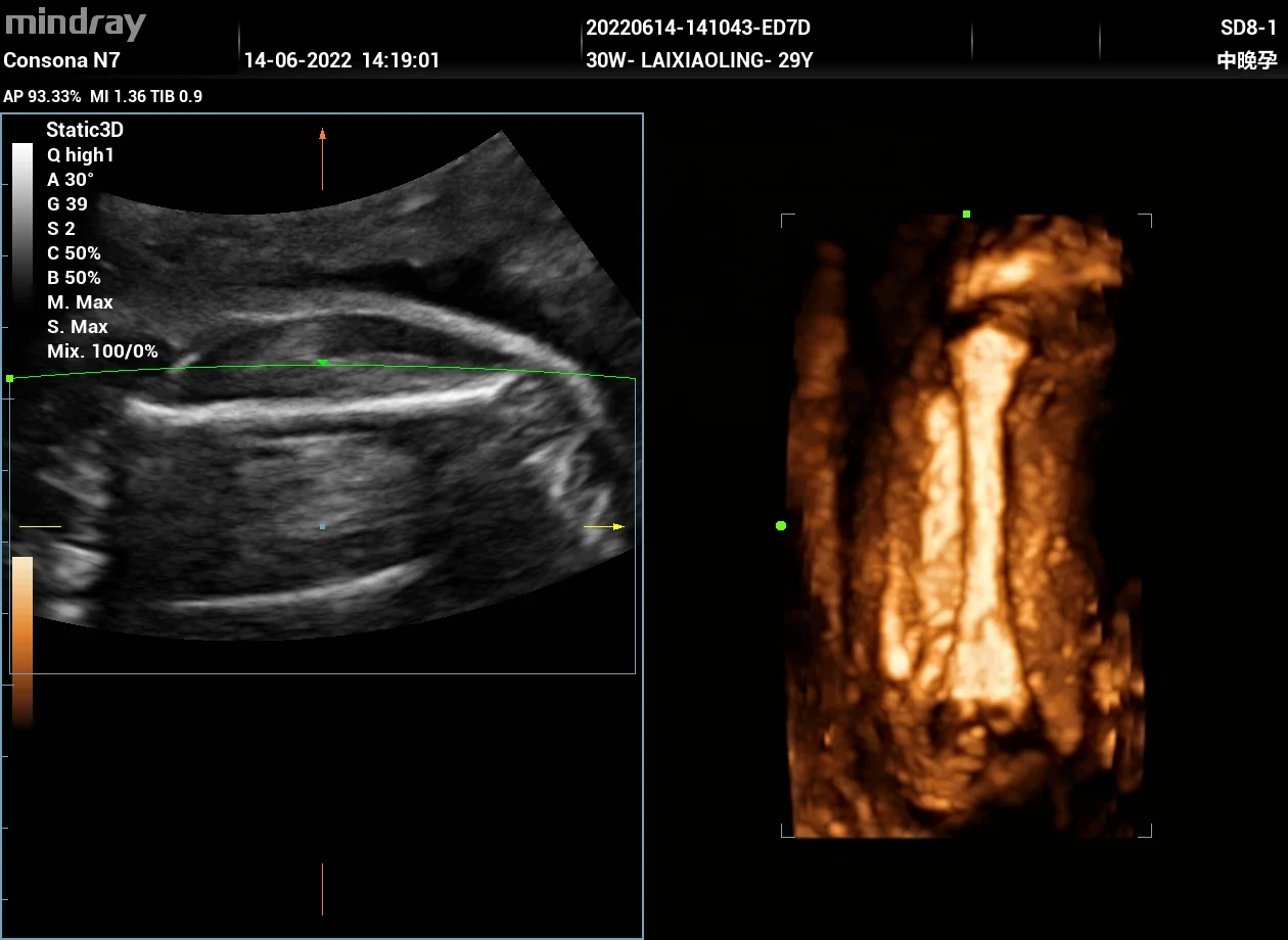 Hueso largo fetal en 3D