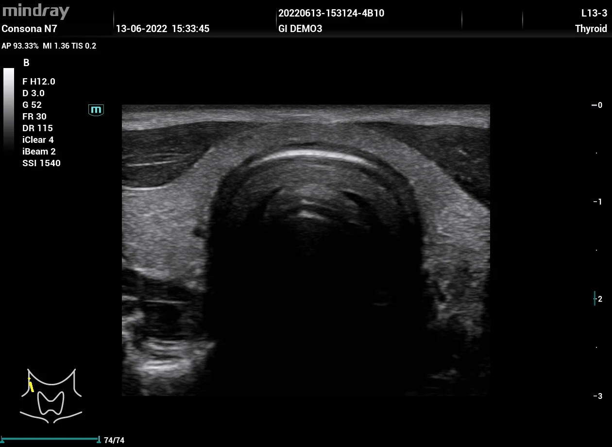 Tiroides, plano axial