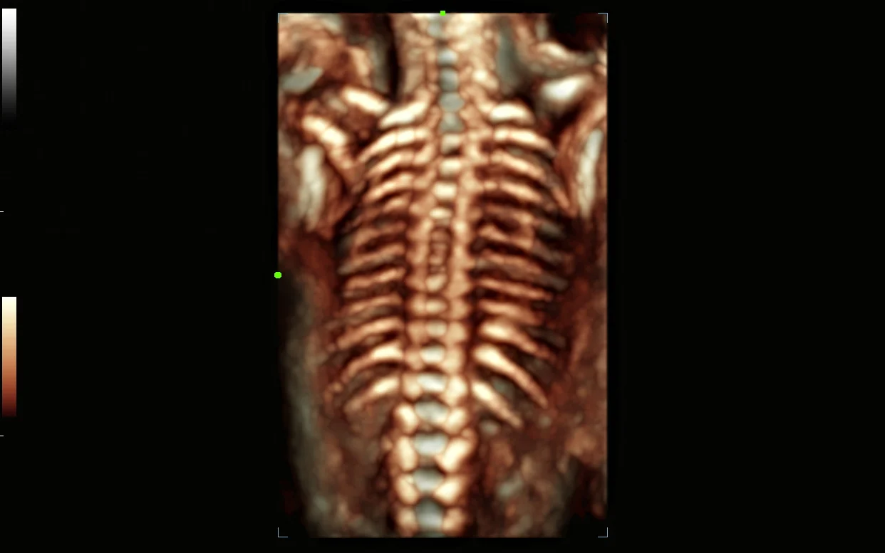 Columna fetal en 3D
