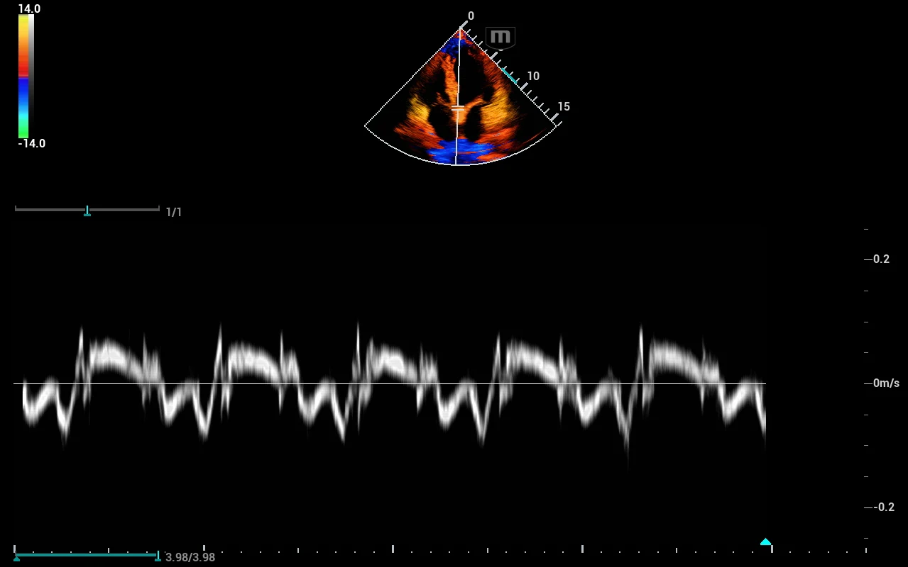 Doppler tisular en 4 cámaras