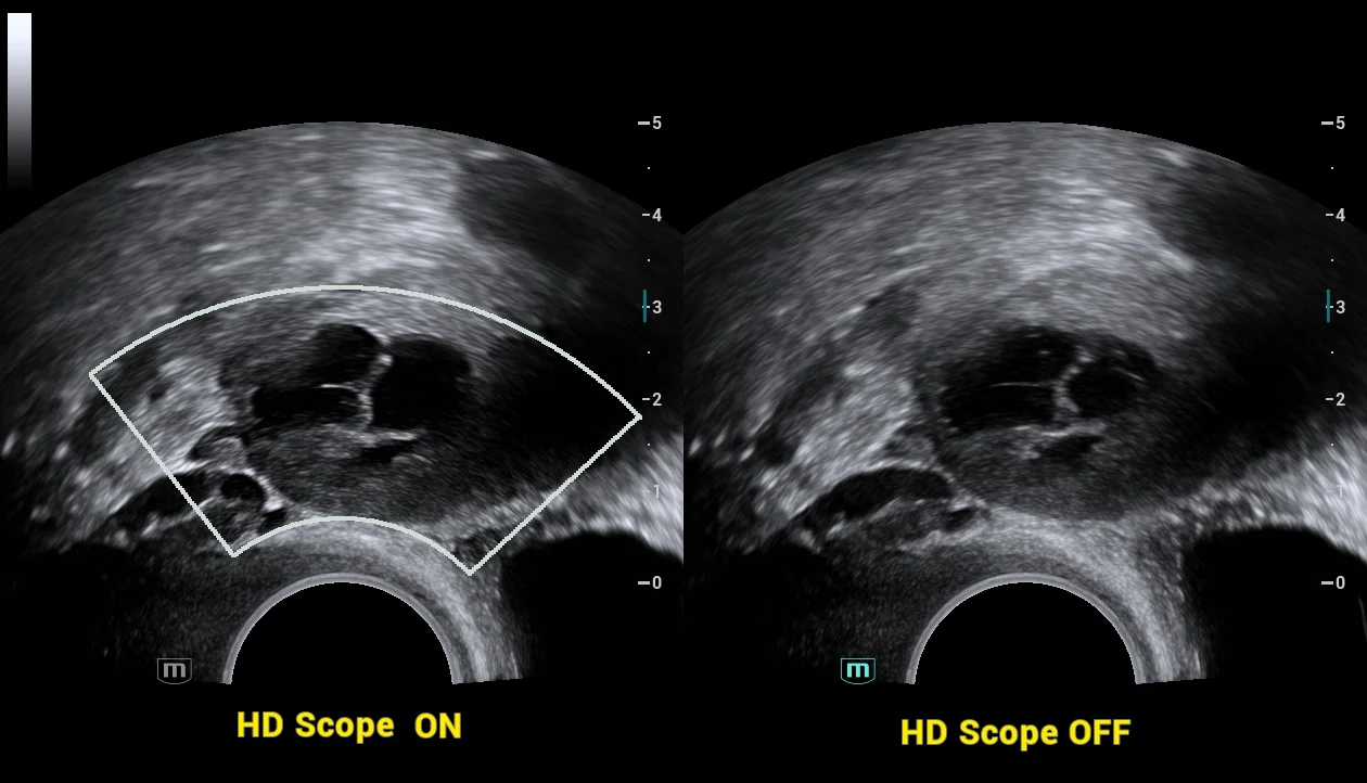 Ovario con HD Scope