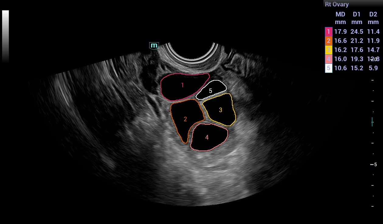 Smart FLC — recuento folicular