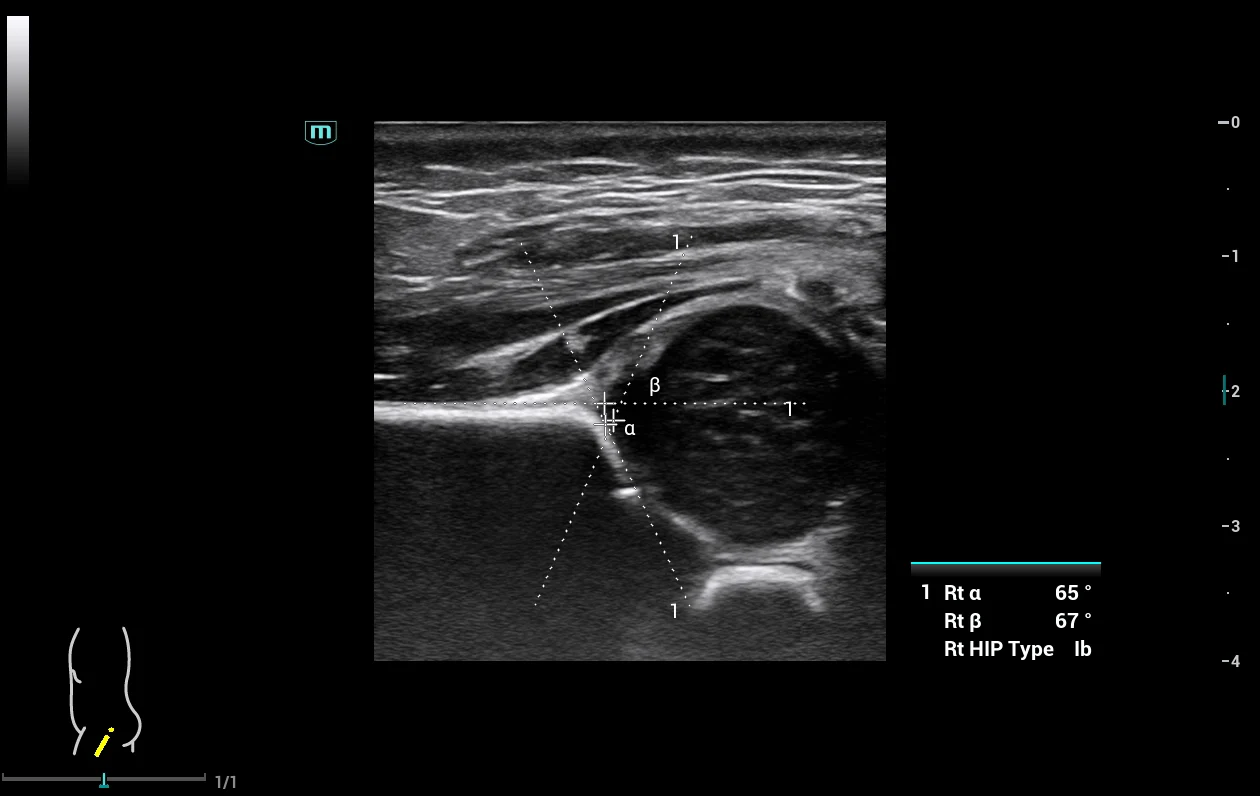 Smart Hip — cadera neonatal