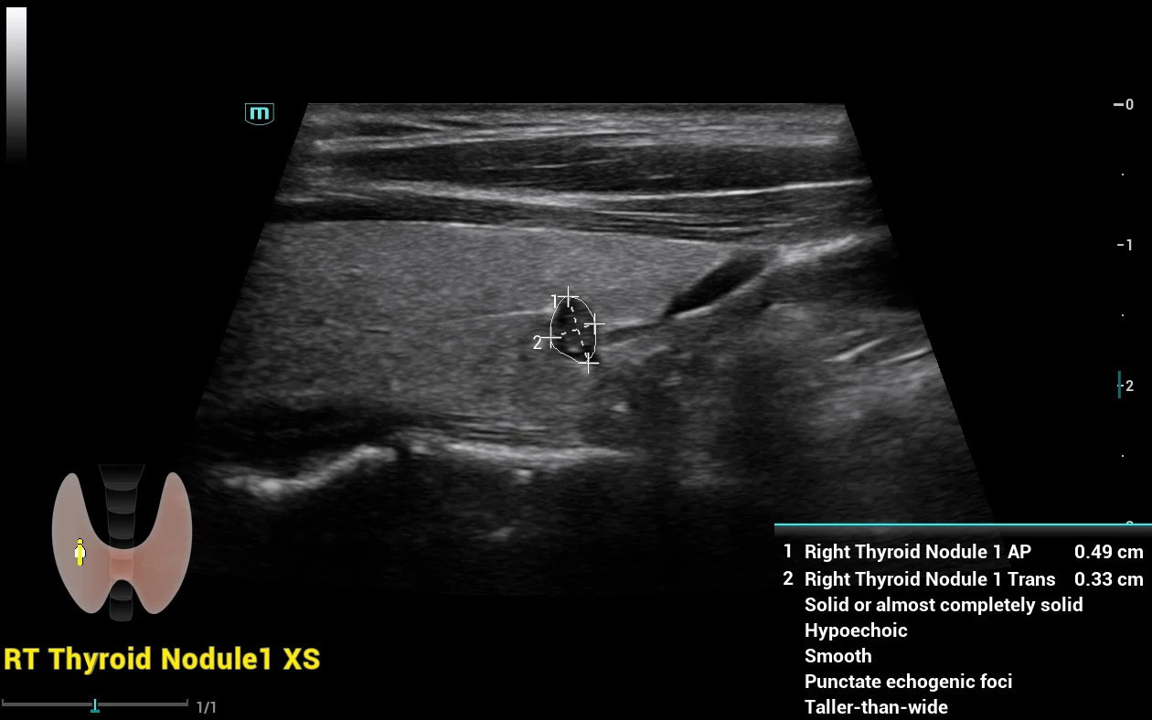 Smart Thyroid (ACR TI-RADS)