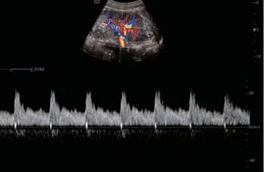 Arteria renal con PW