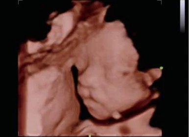 Cara fetal 3D con iLive