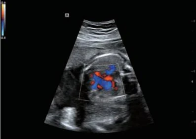 Corazón fetal con CFM