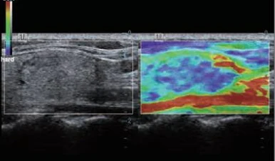 Elastografía tiroidea