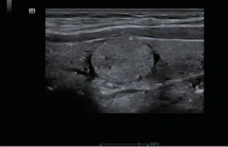 Adenoma tiroideo