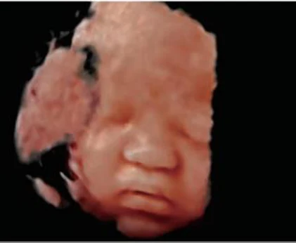 Rostro fetal 3D con iLive