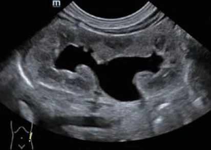 Hidronefrosis pediátrica