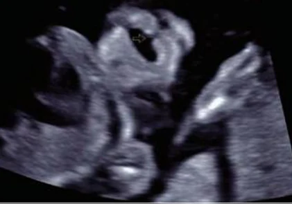 Labio hendido fetal