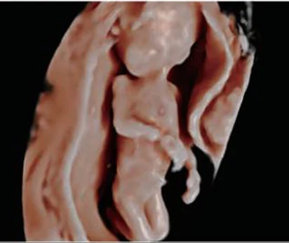 Perfil fetal de 12 semanas