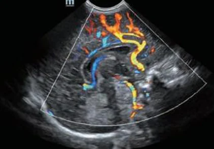 Perfusión cerebral neonatal