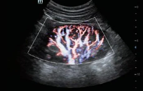 Perfusión renal con HR Flow