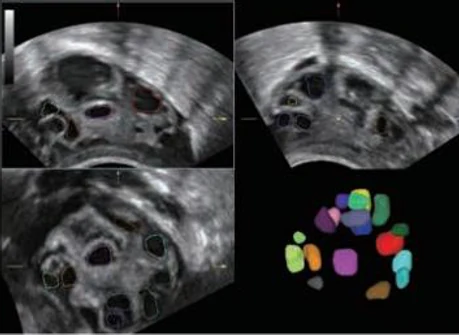 Smart FLC — recuento folicular