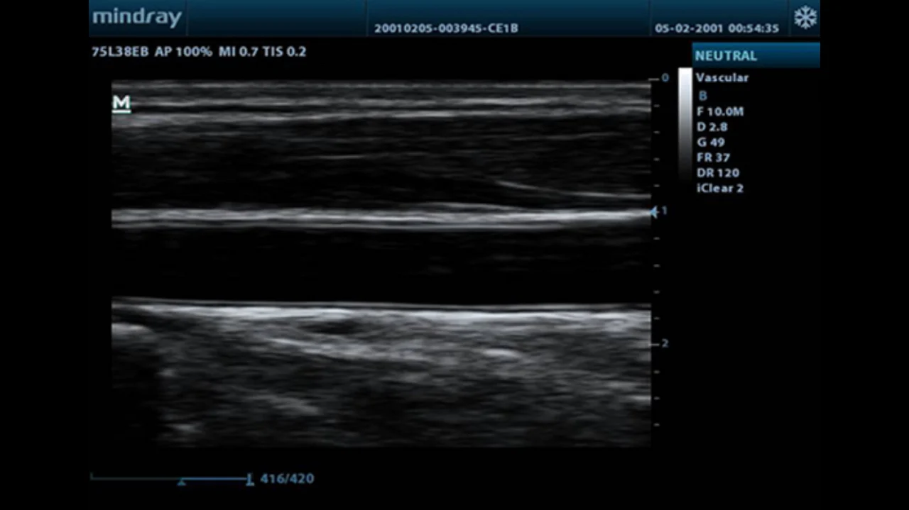 Estudio vascular