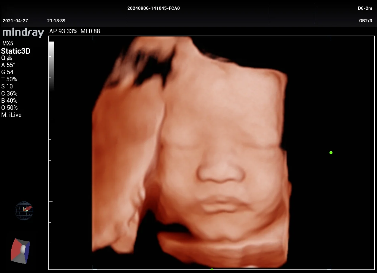 Cara fetal 3D con iLive