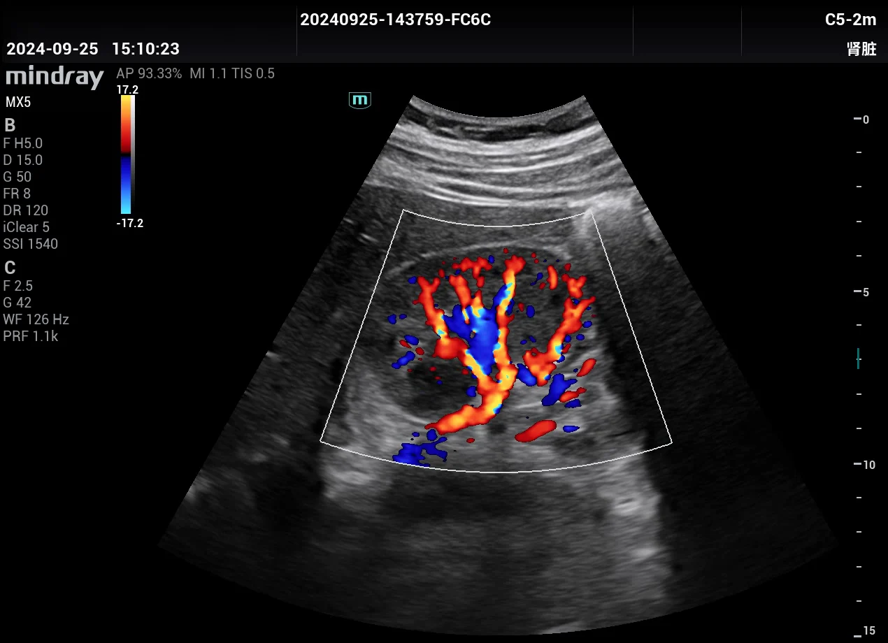 Flujo renal en color