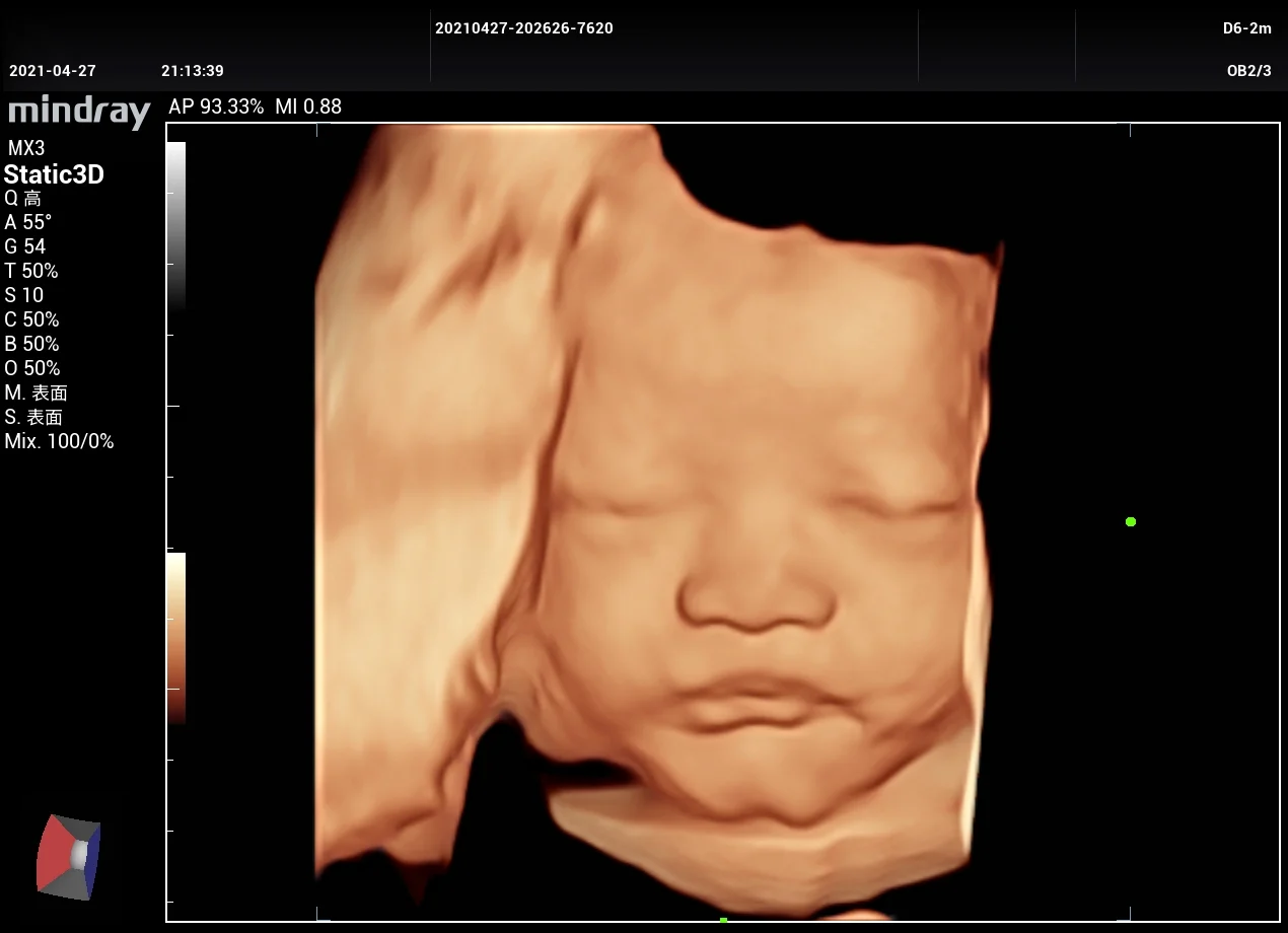 Cara fetal 3D