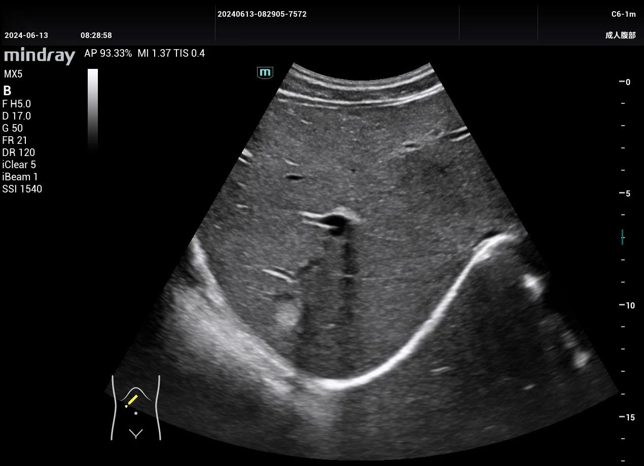 Hemangioma hepático