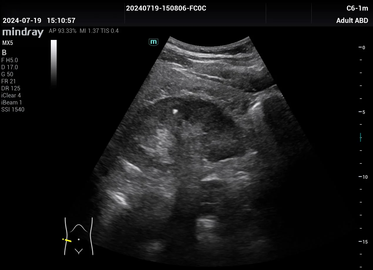 Litiasis renal