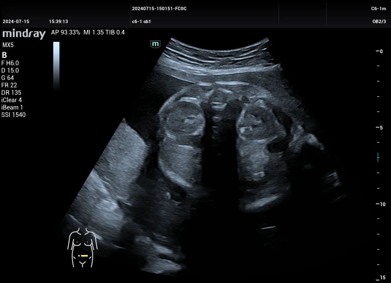 Abdomen fetal