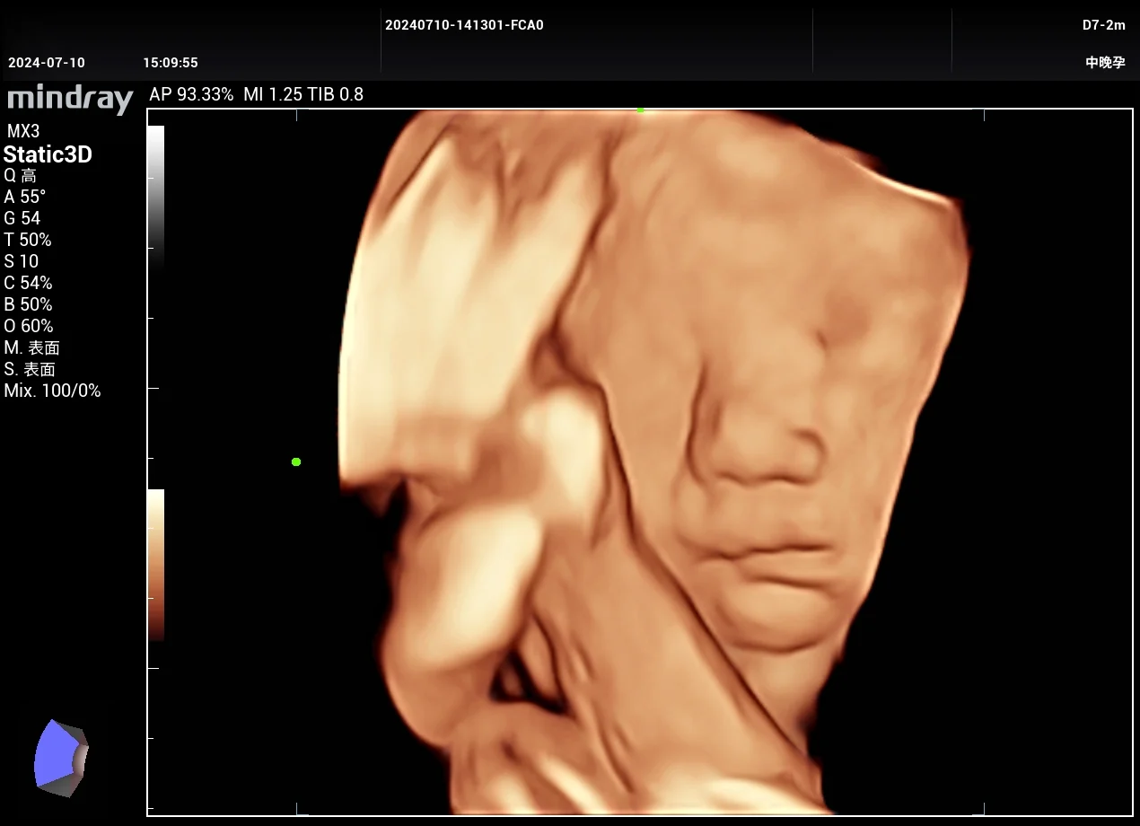 Cara fetal 3D