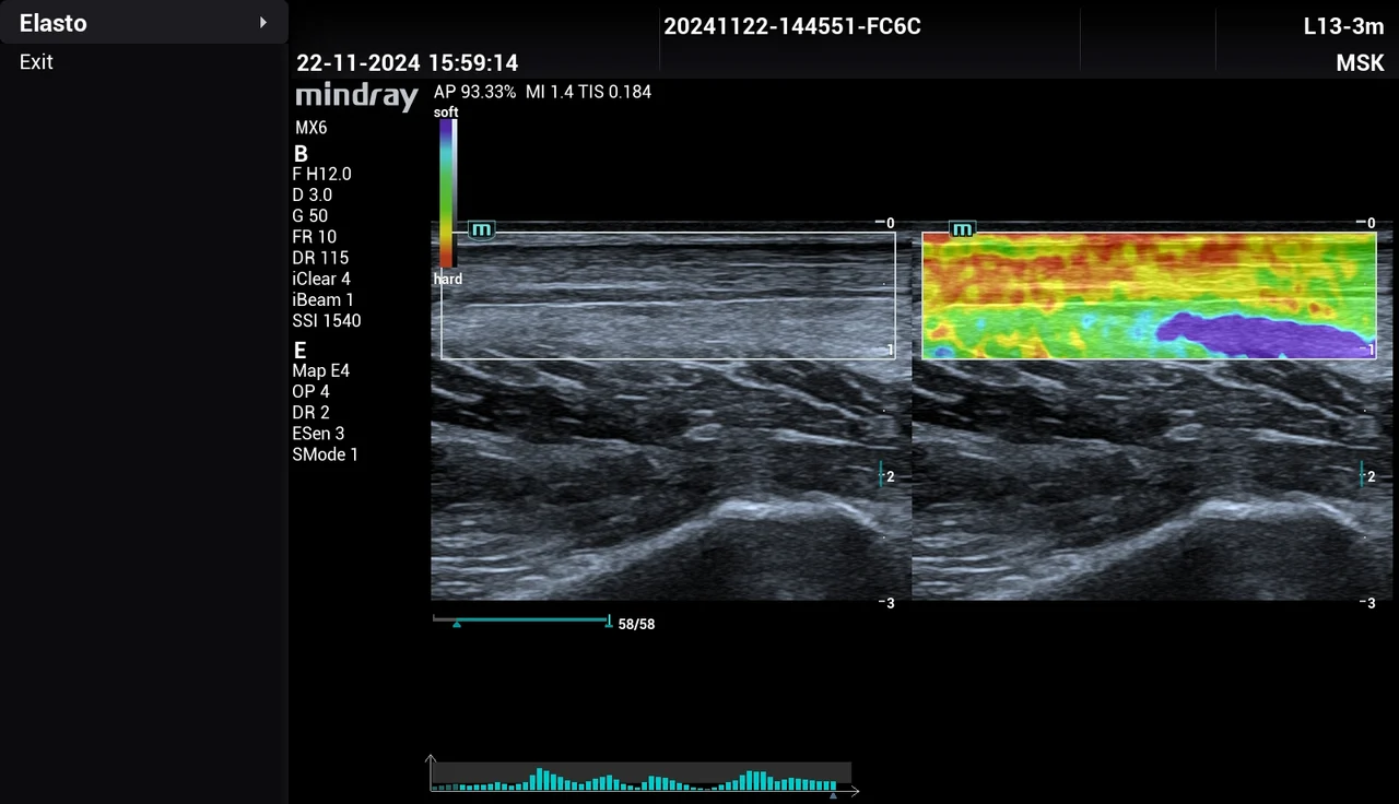 Elastografía NTE en MSK